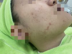 -苗医生草本科技祛痘