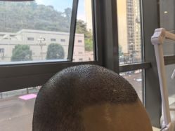 -碧莲盛·不剃发植发