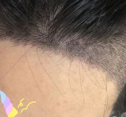 -大麦微针植发丨全国连锁