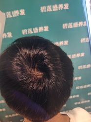 -碧莲盛·不剃发植发