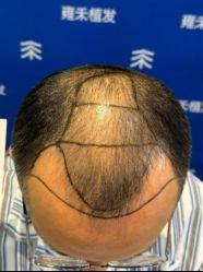 -雍禾植发全国连锁