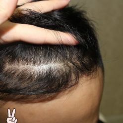 -大麦微针植发丨全国连锁