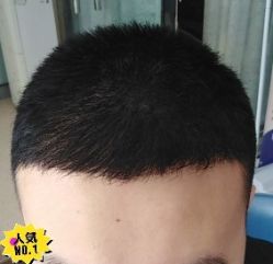 -大麦微针植发丨全国连锁