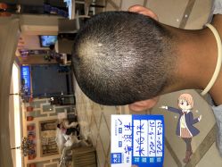 -大麦微针植发丨全国连锁