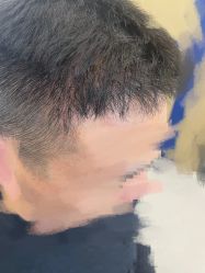 -大麦微针植发全国连锁