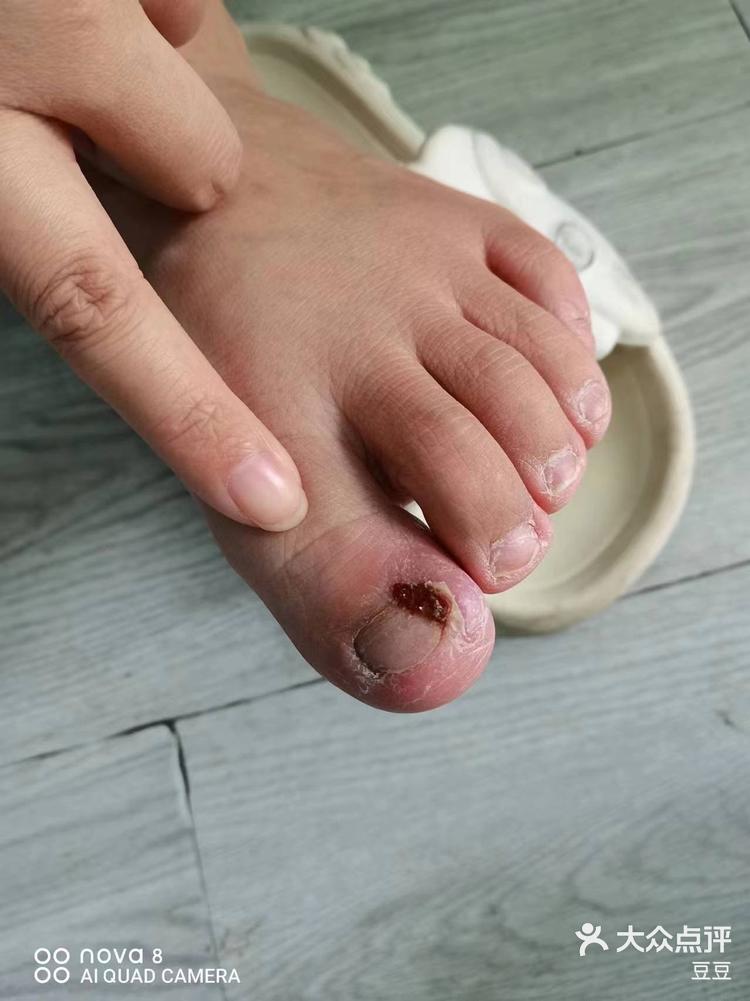 痛苦的甲沟炎