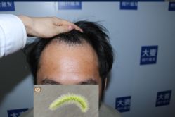 -大麦微针植发全国连锁
