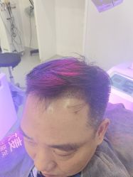 体验后-大麦微针植发全国连锁