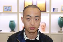 点击看大图 -大麦微针植发丨全国连锁