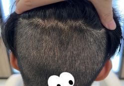 -大麦微针植发全国连锁