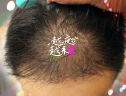 -大麦微针植发全国连锁