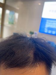 -碧莲盛·不剃发植发