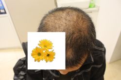 -大麦微针植发丨全国连锁