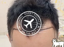 -大麦微针植发全国连锁