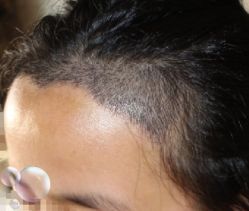 -大麦微针植发丨全国连锁