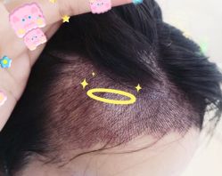 -大麦微针植发全国连锁