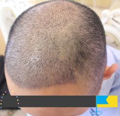 -大麦微针植发丨全国连锁