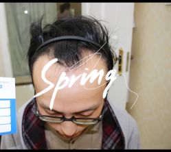 体验前-大麦微针植发全国连锁