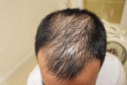 -大麦微针植发丨全国连锁