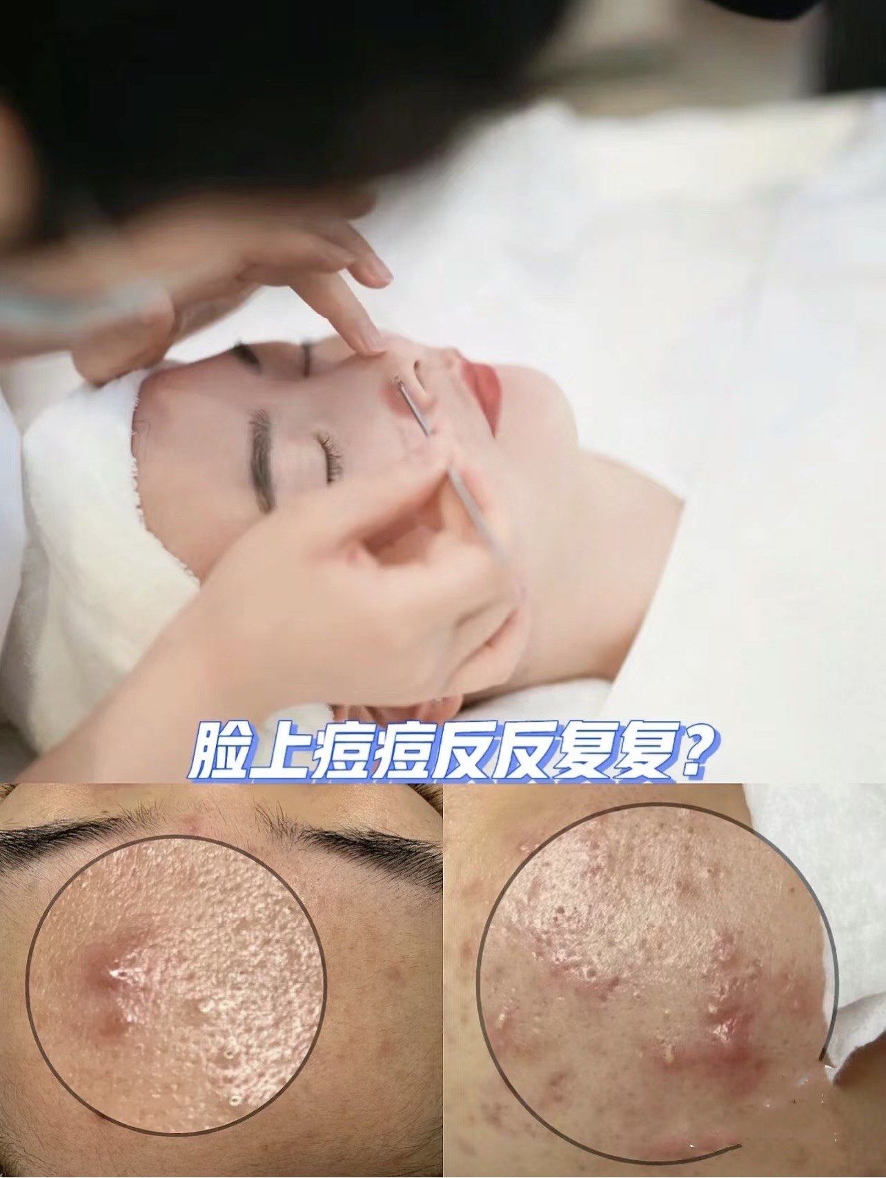痘肌护理