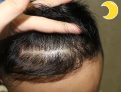 -大麦微针植发丨全国连锁