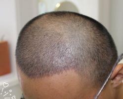 -大麦微针植发丨全国连锁