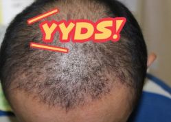 -大麦微针植发丨全国连锁