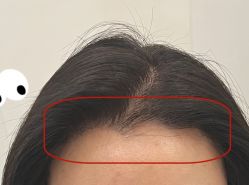 -大麦微针植发全国连锁