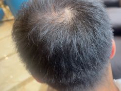 -碧莲盛·不剃发植发