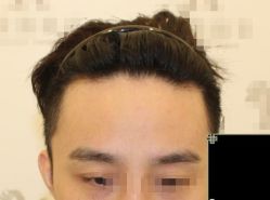 -大麦微针植发丨全国连锁