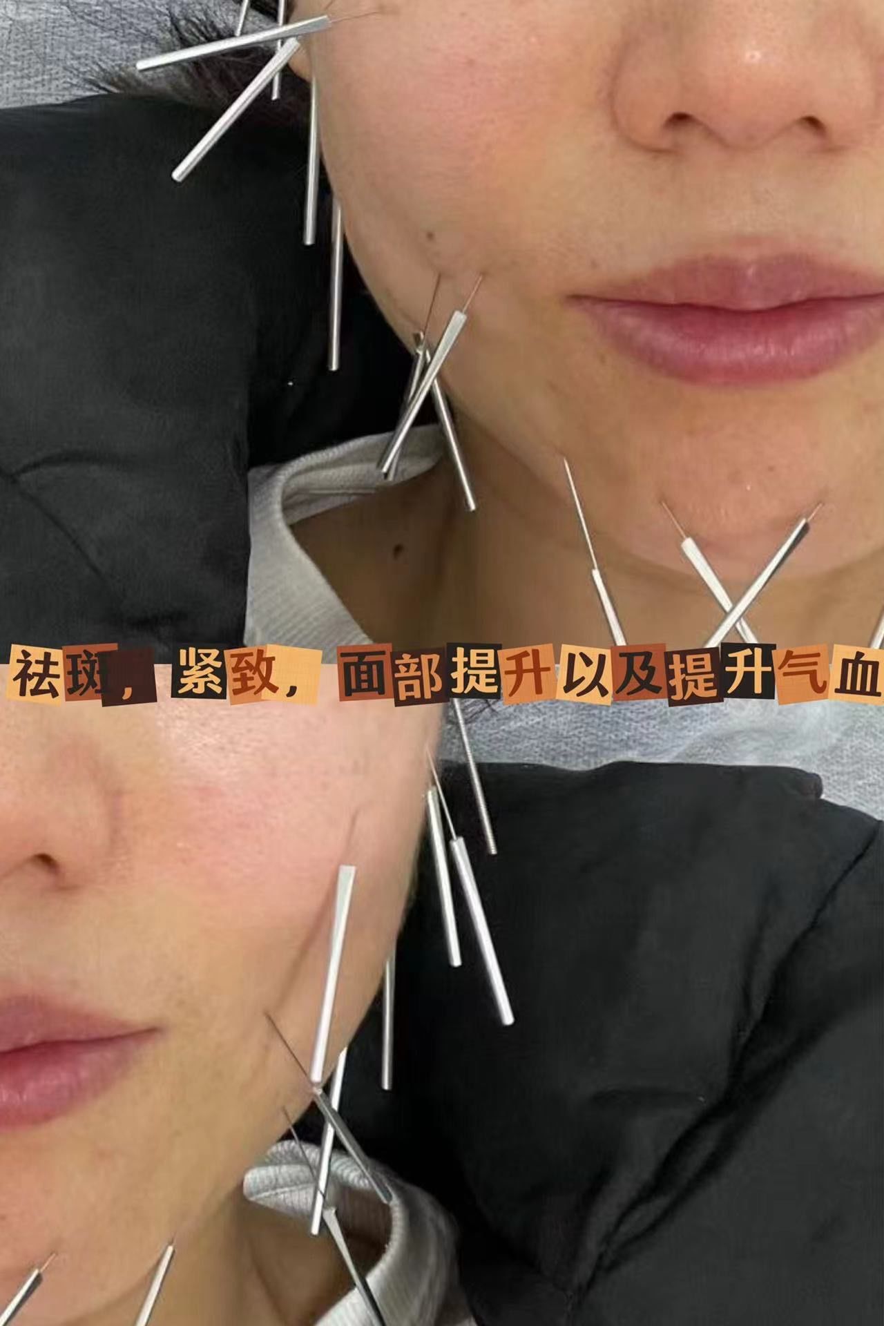 针灸美容:为你揭开肌肤焕颜之谜