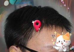 -大麦微针植发全国连锁