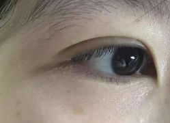 -北京美痣堂古方祛痣斑疣瘊
