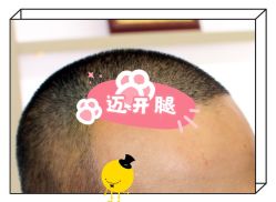 -大麦微针植发全国连锁