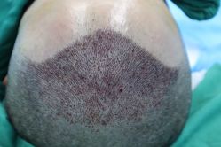 体验后-大麦微针植发全国连锁