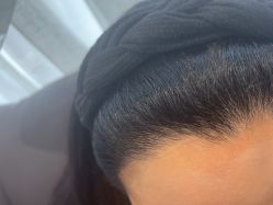 -碧莲盛·不剃发植发