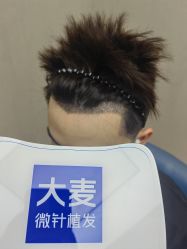 体验后-大麦微针植发全国连锁