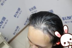 点击看大图 -大麦微针植发丨全国连锁