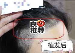 -大麦微针植发全国连锁