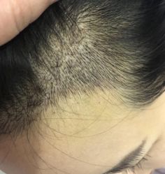 -大麦微针植发丨全国连锁