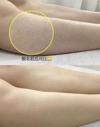 -薇兰专业脱毛连锁机构