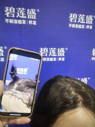 -碧莲盛·不剃发植发