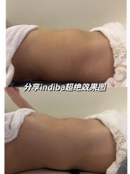 -半岛故事·法儿曼抗衰·indiba中心