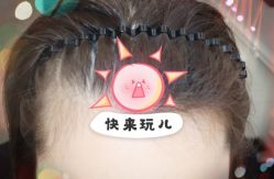 -大麦微针植发全国连锁