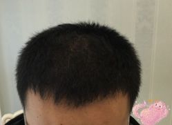 -大麦微针植发丨全国连锁