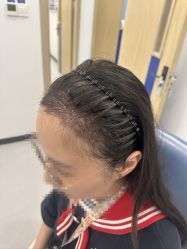 -大麦微针植发全国连锁