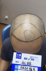 -大麦微针植发全国连锁