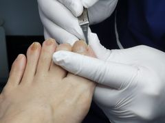 -Andrew指甲专科灰指甲·甲沟炎矫正·3D步态矫形鞋垫定制(上海法华镇路旗舰店)