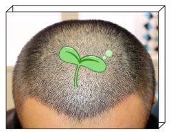 -大麦微针植发全国连锁