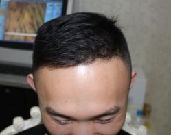 -大麦微针植发全国连锁